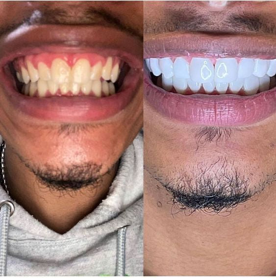 Glorysmile V34 Dentifrice Violet Blanchissant – Menthe Fraîche & Nettoyage Profond
 (6,432avis clients )